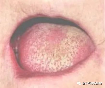 Tongue Diagnosis in Traditional Chinese Medicine: Tongue Coating