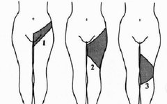 Diagnosis and Inquiry of Low Back Pain