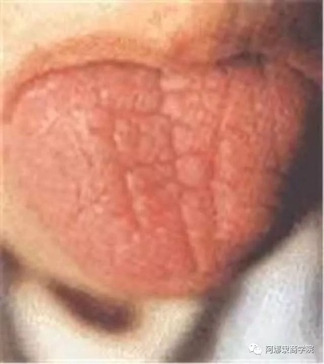 A Comprehensive Guide to 22 High-Definition Tongue Diagnosis Images: Understand Diseases Through Tongue Observation!
