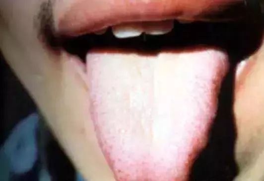 The Most Comprehensive Guide to Tongue Diagnosis! Master It and Become a Tongue Diagnosis Expert