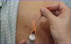 What Common Skin Diseases Can Fire Needle Therapy Treat?