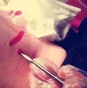 Bloodletting Therapy in Traditional Chinese Medicine: A Pathway to Healing