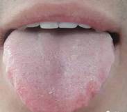 Comprehensive Guide to Tongue Diagnosis: Easily Understand Your Health Condition