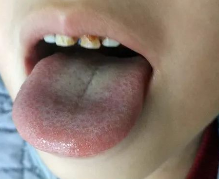High-Definition Tongue Diagnosis Atlas for Children: Understanding Tongue Diagnosis (A Must-Collect)