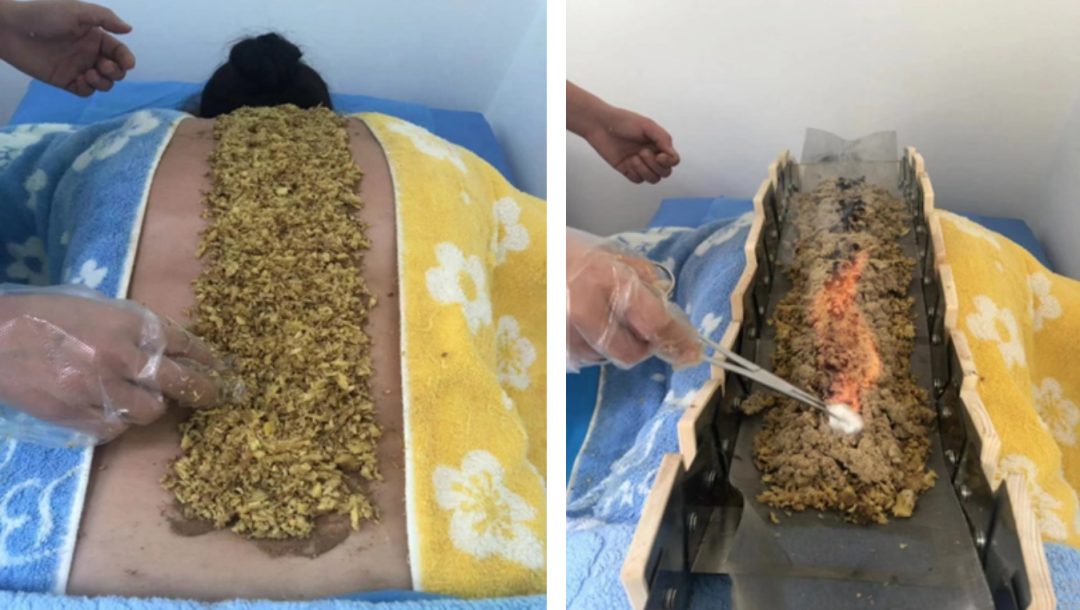 Specialized Therapies | Various Unique Moxibustion Techniques in TCM for Health and Disease Prevention