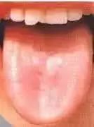 Comprehensive Guide to Tongue Diagnosis: Learn How Your Tongue Reflects Your Health!