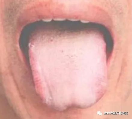 Tongue Diagnosis in Traditional Chinese Medicine: Tongue Coating