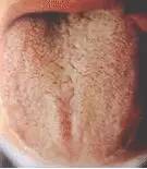 Comprehensive Guide to Tongue Diagnosis: Easily Understand Your Health Condition