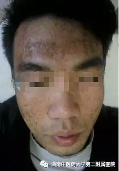 Unique Techniques of Fire Needle Therapy for Skin Diseases
