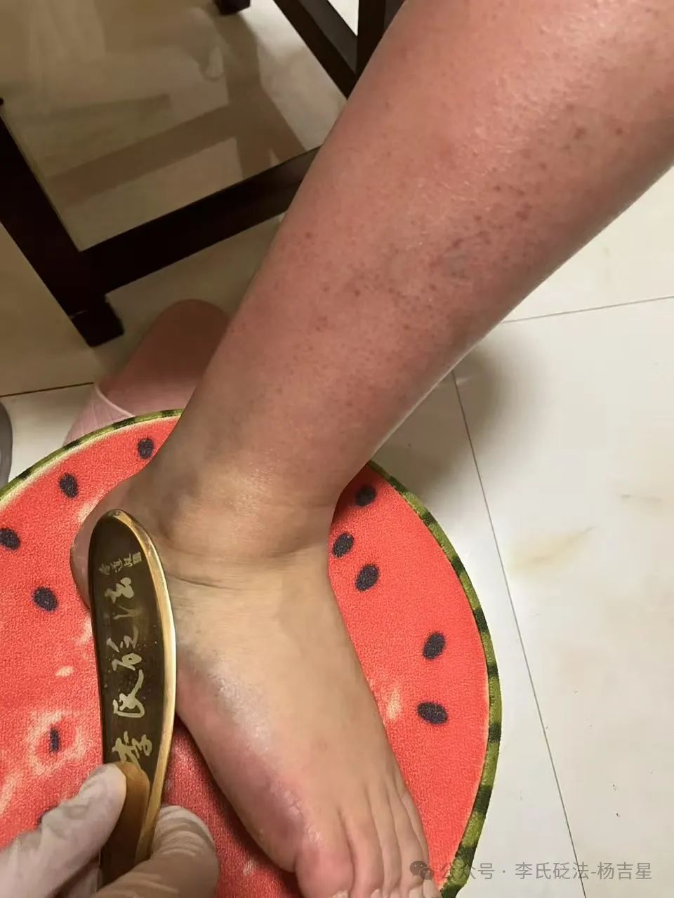 How to Use Gua Sha for Gout Management? Case Study (1)