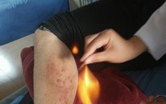 The Development and Clinical Significance of Miao Fire Needle Therapy