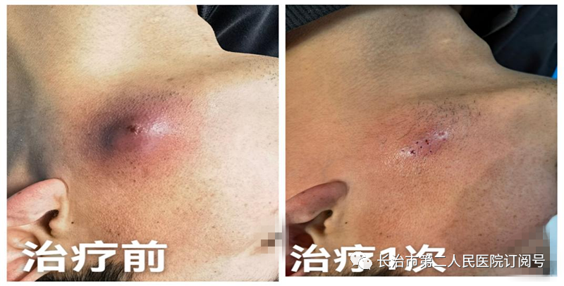 The Power of Fire Needling in Treating Skin Diseases