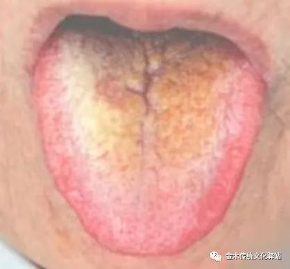 Tongue Diagnosis in Traditional Chinese Medicine: Tongue Coating