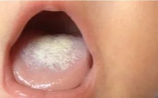 Observing Tongue Coating to Predict Diseases