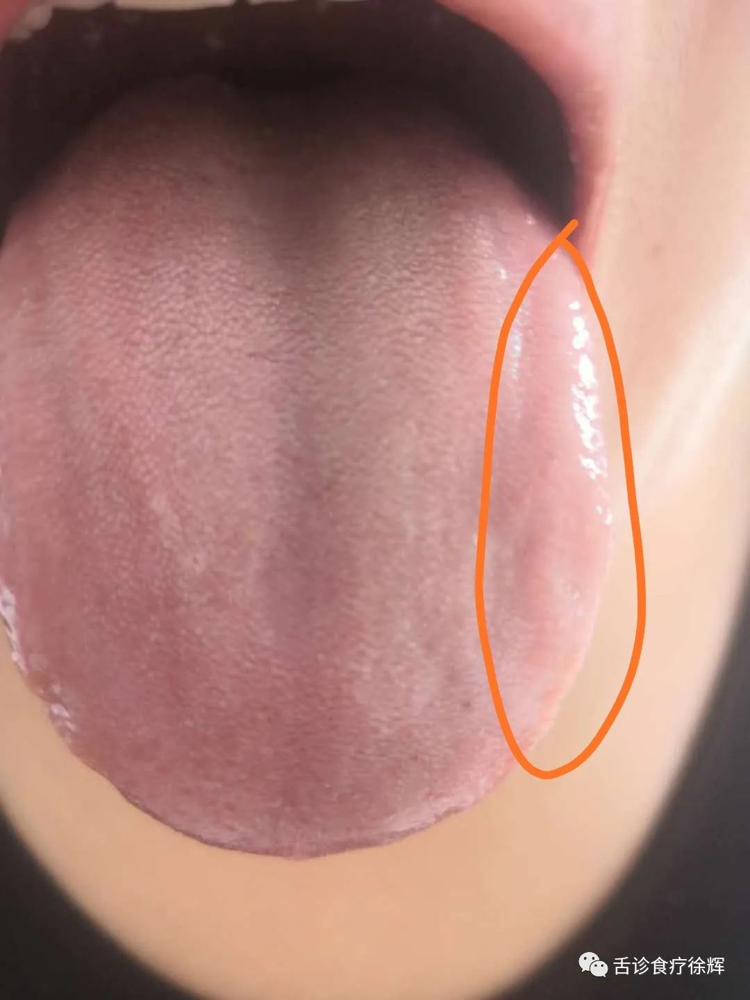 Distinguishing Between Yang Deficiency and Blood Deficiency with Pale Tongue