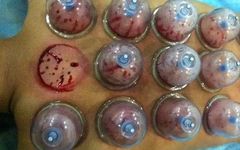 The Therapeutic Effects of Bloodletting in Traditional Chinese Medicine