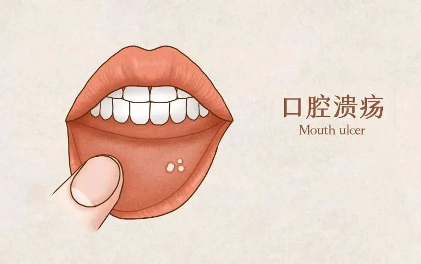 What to Eat for Oral Ulcers? Simple Home Remedies to Banish Oral Ulcers
