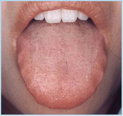 Traditional Chinese Medicine Tongue Diagnosis - Tongue Coating