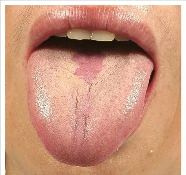 Traditional Chinese Medicine Tongue Diagnosis: 26 Clinical High-Definition Tongue Diagnosis Images with Analysis