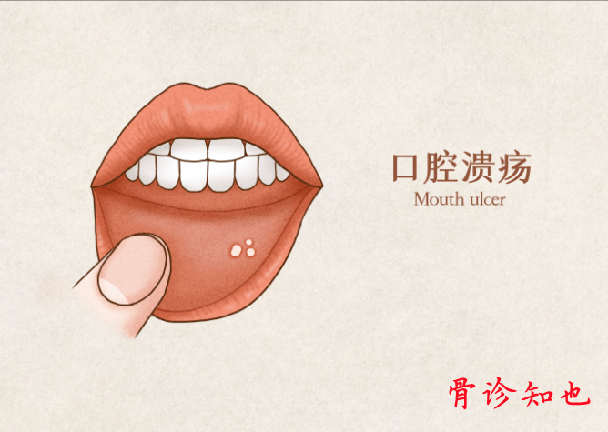 Bloodletting Therapy for 24 Difficult Diseases