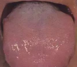 Understanding Tongue Diagnosis in Traditional Chinese Medicine (with Tongue Diagnosis Illustrations)