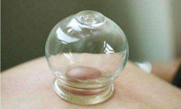 Cupping Therapy: A Traditional Chinese Medicine Approach to Health