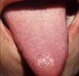 Tongue Diagnosis - Illustrated Guide to Tongue Manifestations