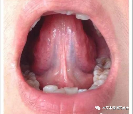 Tongue Diagnosis Series 3: Precise Differentiation of Tongue Coating, Quality, and Shape