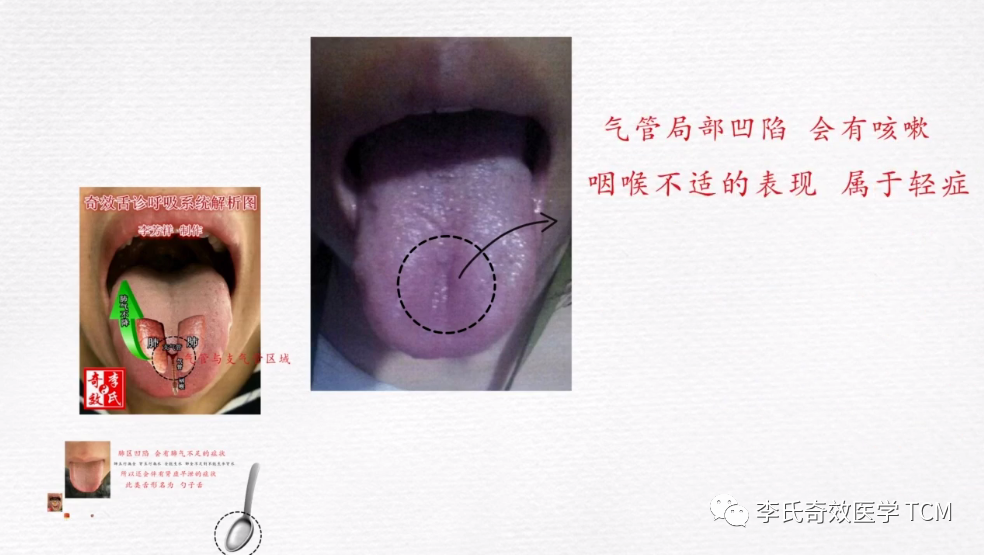 Tongue Diagnosis and the Lungs (Animated Version)