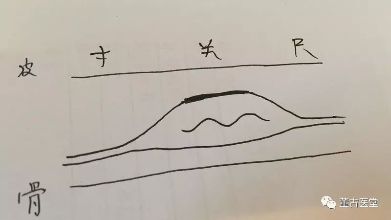 Clinical Application of Xuan Hua Pulse in TCM: A Case Study on Insomnia