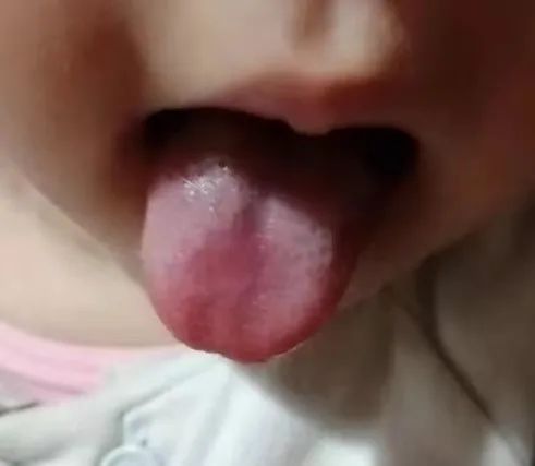 Case Study | Diarrhea with Mixed Cold and Heat Symptoms