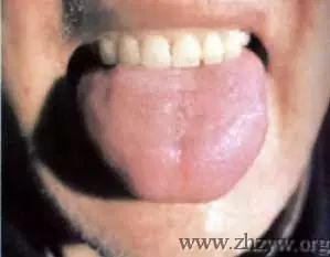 Traditional Chinese Medicine Tongue Diagnosis - Tongue Coating