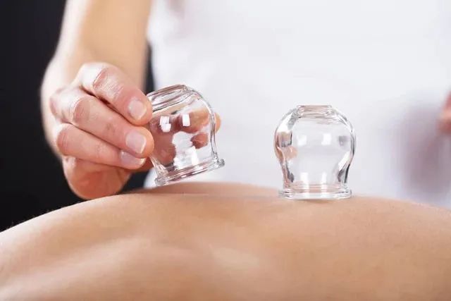Cupping Therapy: A Traditional Chinese Medicine Approach to Health