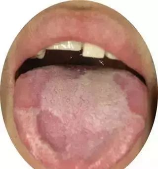 The Most Comprehensive Guide to Tongue Diagnosis! Master It and Become a Tongue Diagnosis Expert