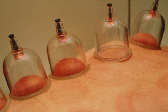 Understanding Cupping Therapy: Common Misconceptions and Precautions