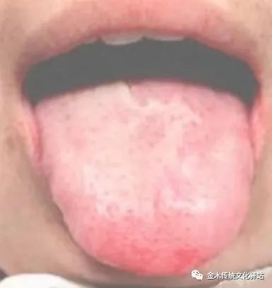 Tongue Diagnosis in Traditional Chinese Medicine: Characteristics of Tongue Coating