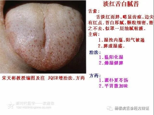 Foundations of Traditional Chinese Medicine: Phlegm-Dampness