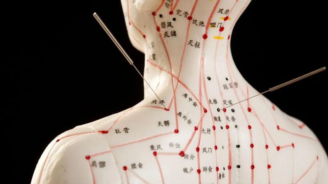 Acupuncture Specialty Treatment - Fire Needle