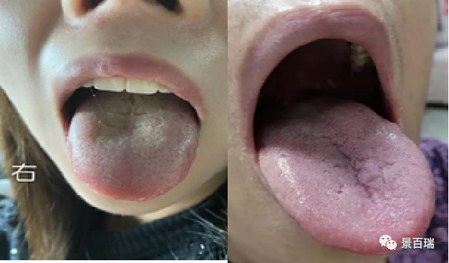 Basic Tongue Diagnosis - Tongue Body and Tongue Coating