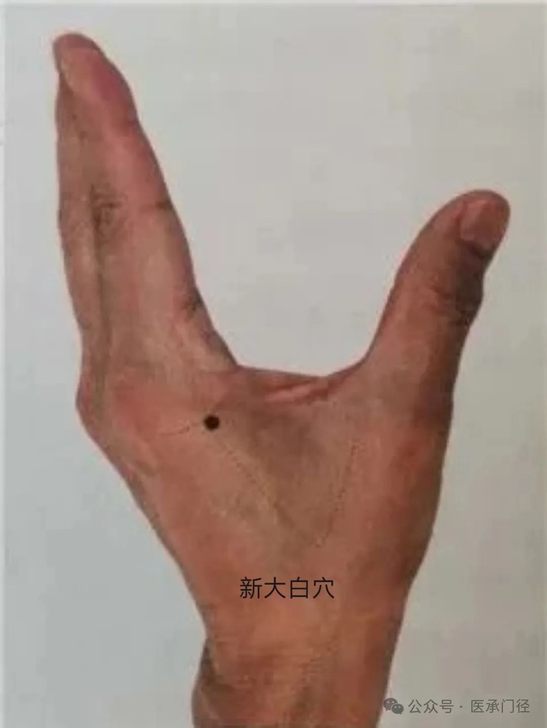 Traditional Fine Needle Technique for Acupuncture Treatment of Sciatica