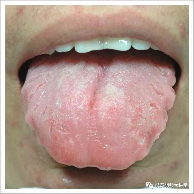 Traditional Chinese Medicine Tongue Diagnosis: Illustrated Guide to 14 Types of Tongue Shapes and Qualities