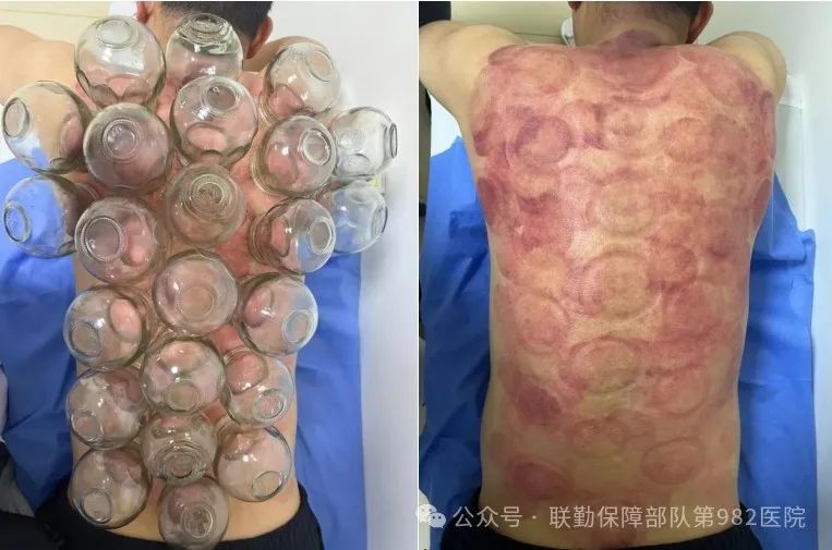 Traditional Chinese Medicine Therapy: 'Leopard Spot' Cupping Therapy