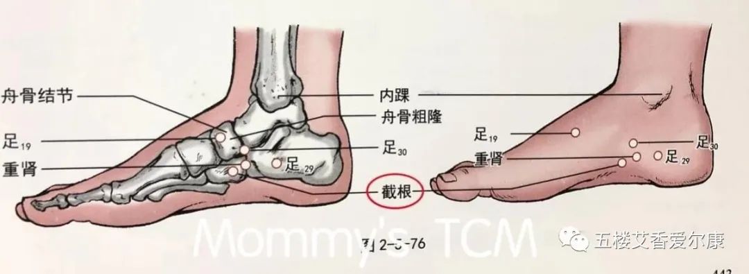 Summary of Common Diseases and Gua Sha Treatment Plans Including Human Reflex Maps, Contraindications, and Diagnosis of Sha Patterns
