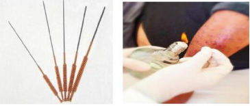 Fire Needle Therapy for Skin Diseases: Visible Safety and Efficacy