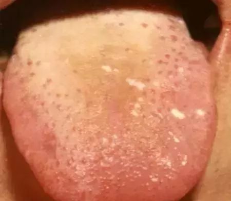The Most Comprehensive Guide to Tongue Diagnosis! Master It and Become a Tongue Diagnosis Expert