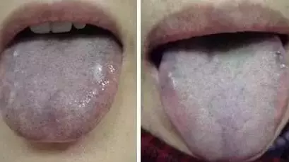 What Does Traditional Chinese Medicine Observe in the Tongue? Nine Body Types and Valuable Tongue Diagnosis Charts!