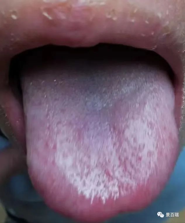 Basic Tongue Diagnosis - Tongue Body and Tongue Coating
