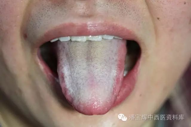 Foundations of Traditional Chinese Medicine: Phlegm-Dampness