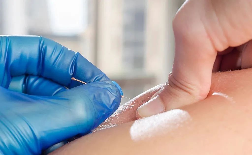 Comprehensive Guide to Acupuncture Techniques: A Lifelong Benefit of Traditional Chinese Medicine!