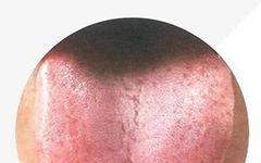 Understanding Tongue Diagnosis in TCM: Insights into Health from Tongue Appearance (Part 2)